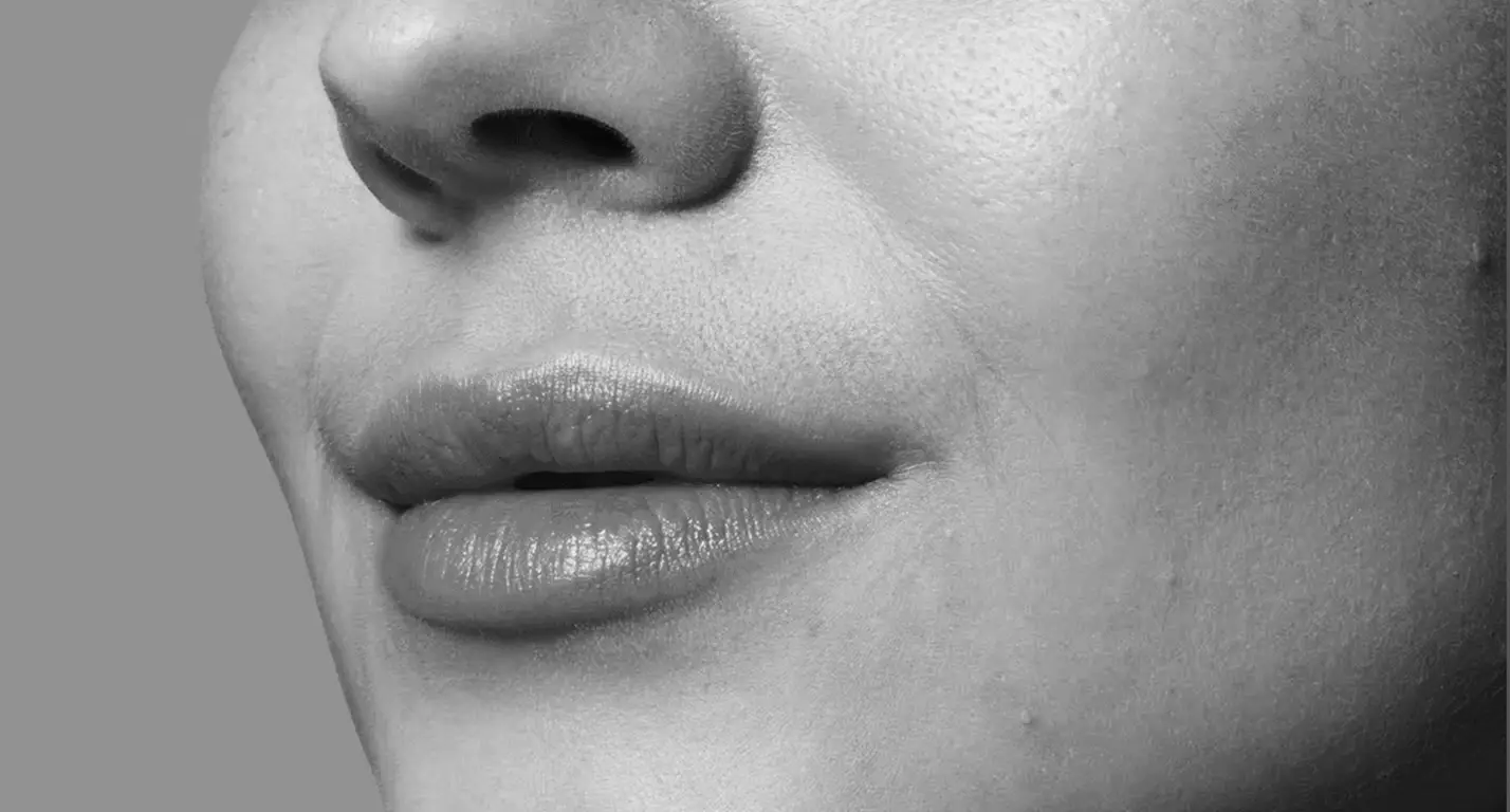 FOR MORE VOLUME AND ELASTICITY: HYALURONIC ACID FILLER