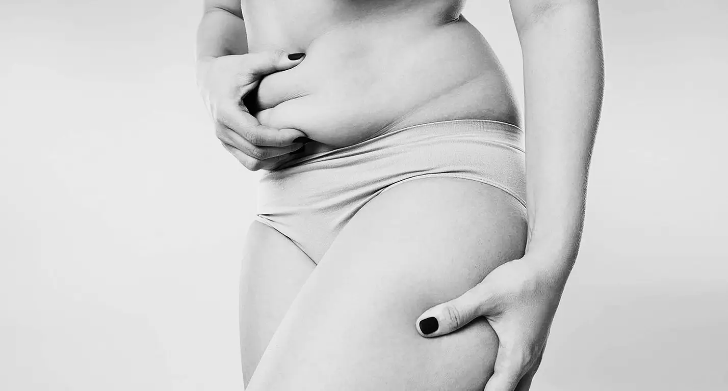 TUMMY TUCK MOMMY MAKEOVER