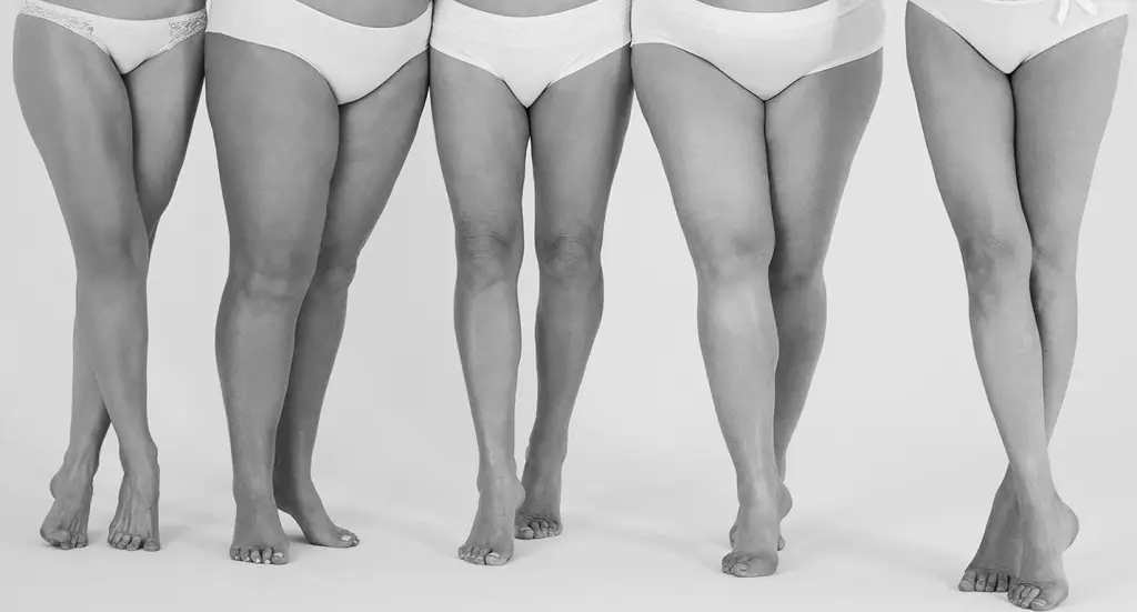 FAT DISTRIBUTION DISORDER ON THE LEGS? LIPEDEMA TREATMENT