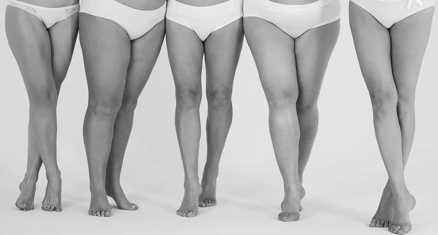FAT DISTRIBUTION DISORDER ON THE LEGS? LIPEDEMA TREATMENT