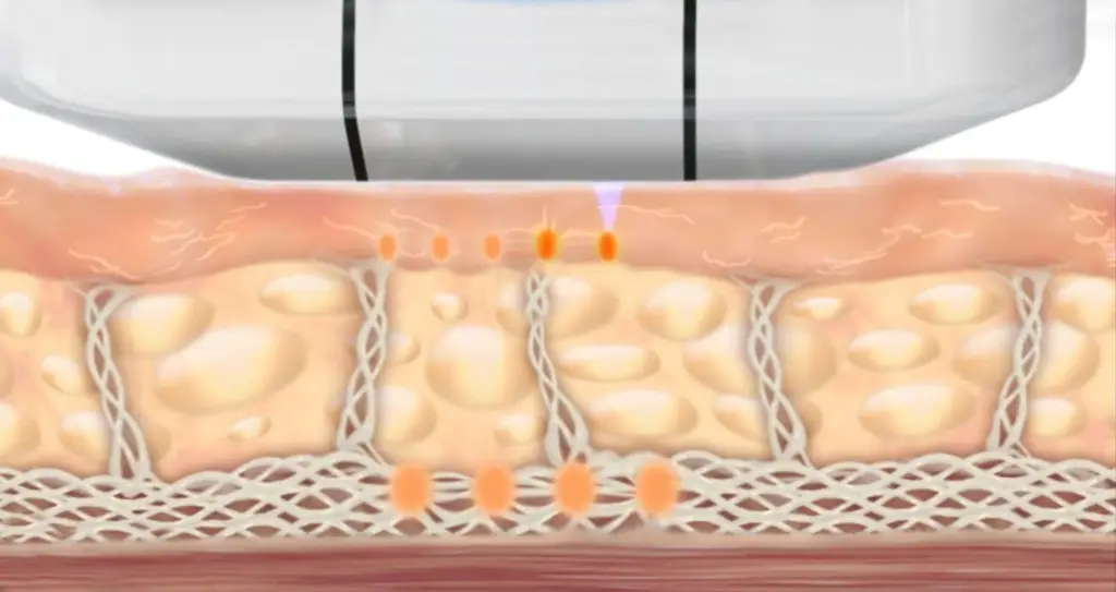 ULTHERA — A MODERN METHOD OF SKIN TIGHTENING BY ULTRASOUND