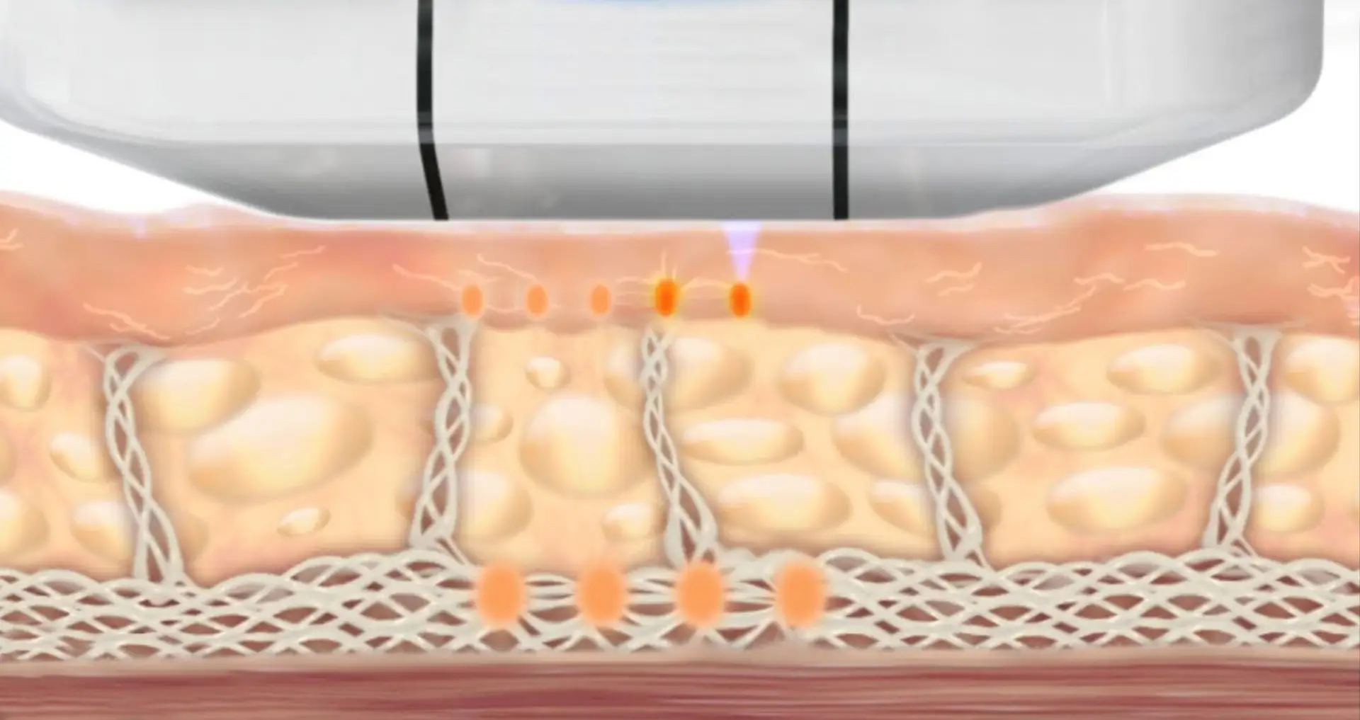 ULTHERA — A MODERN METHOD OF SKIN TIGHTENING BY ULTRASOUND